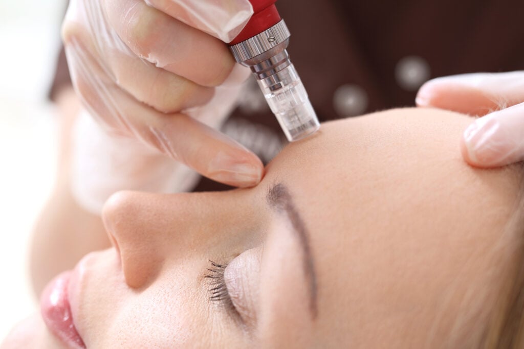 Microneedling 101: What It Is and Why It’s So Popular