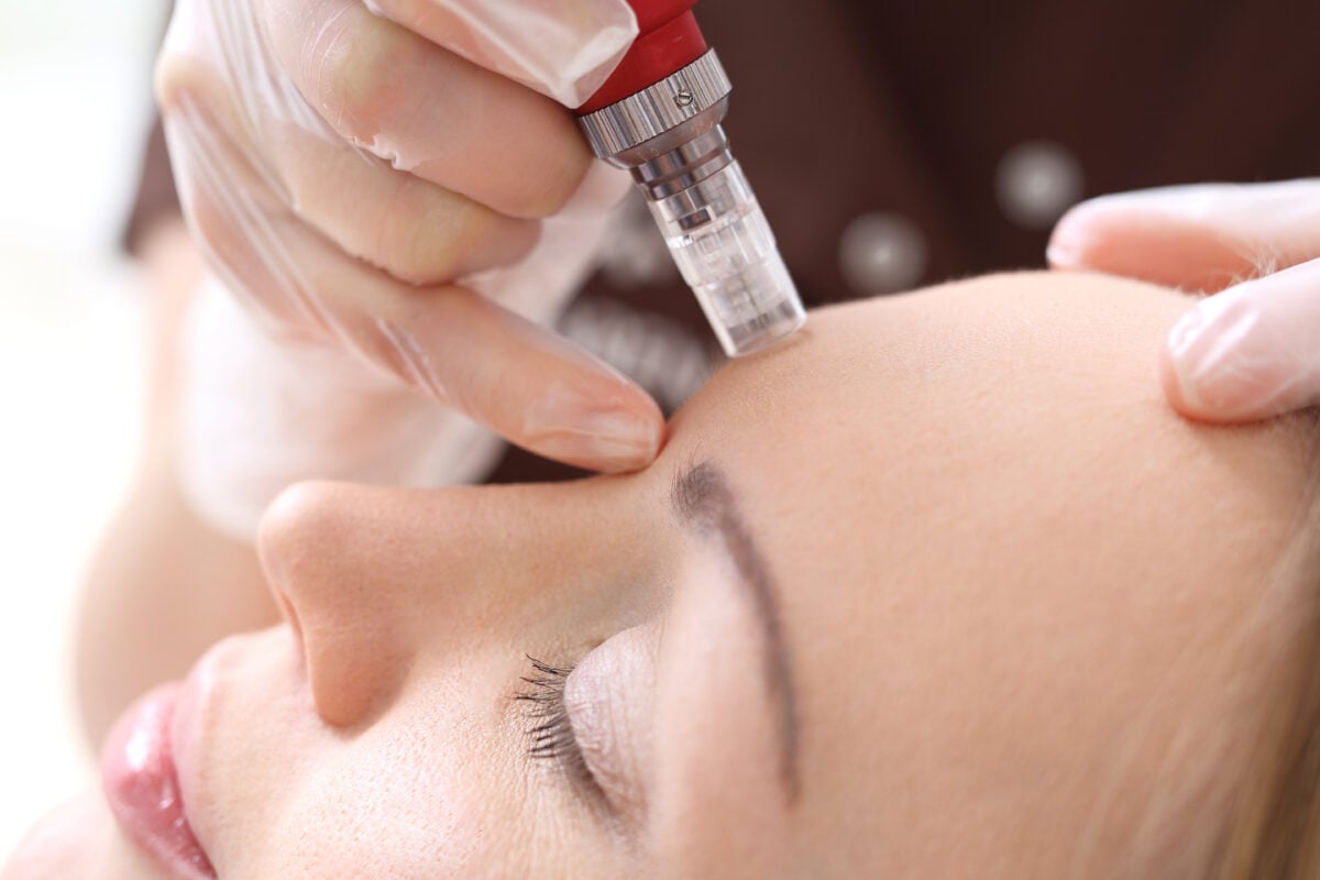 Microneedling 101: What It Is and Why It’s So Popular